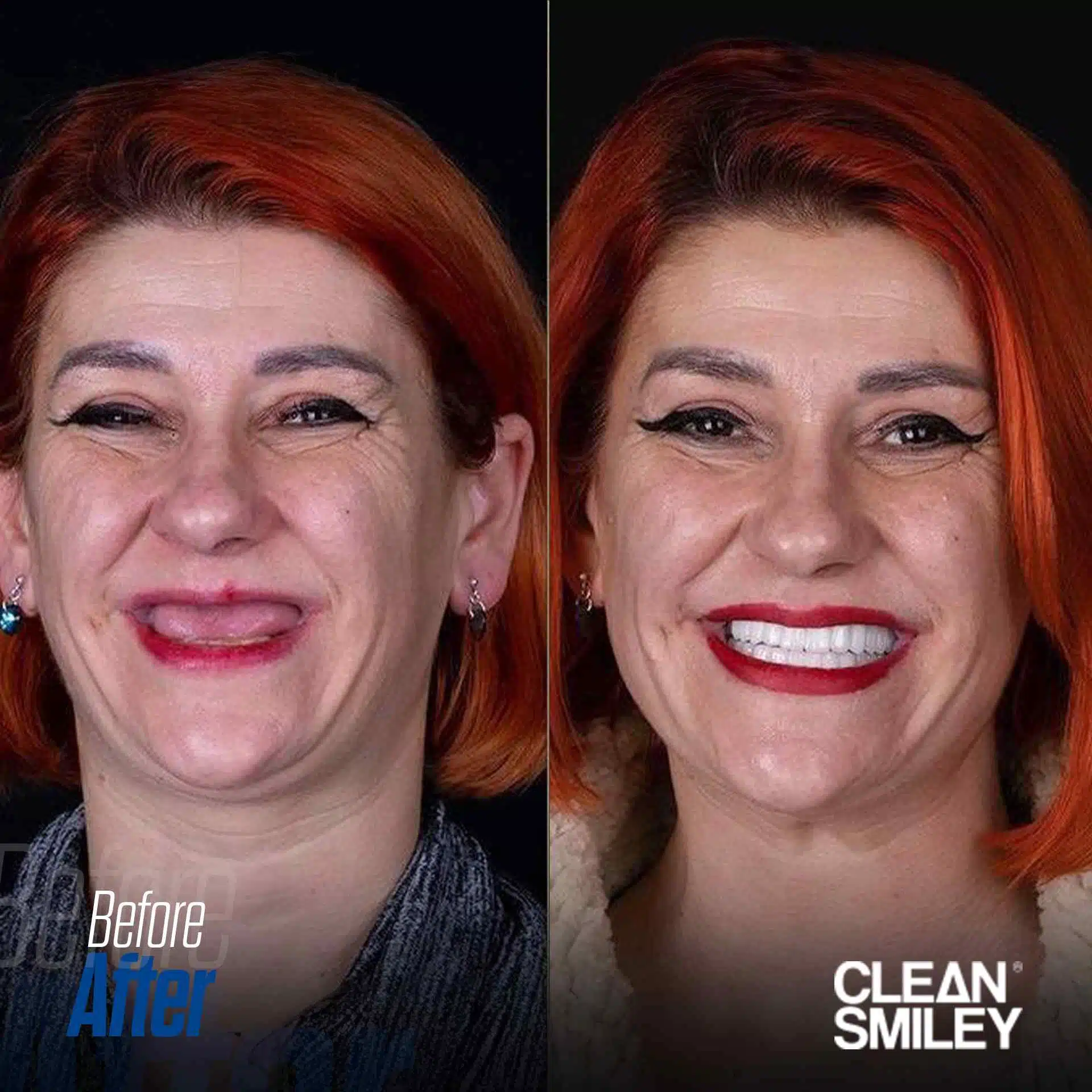 Dental Implants Antalya Turkey