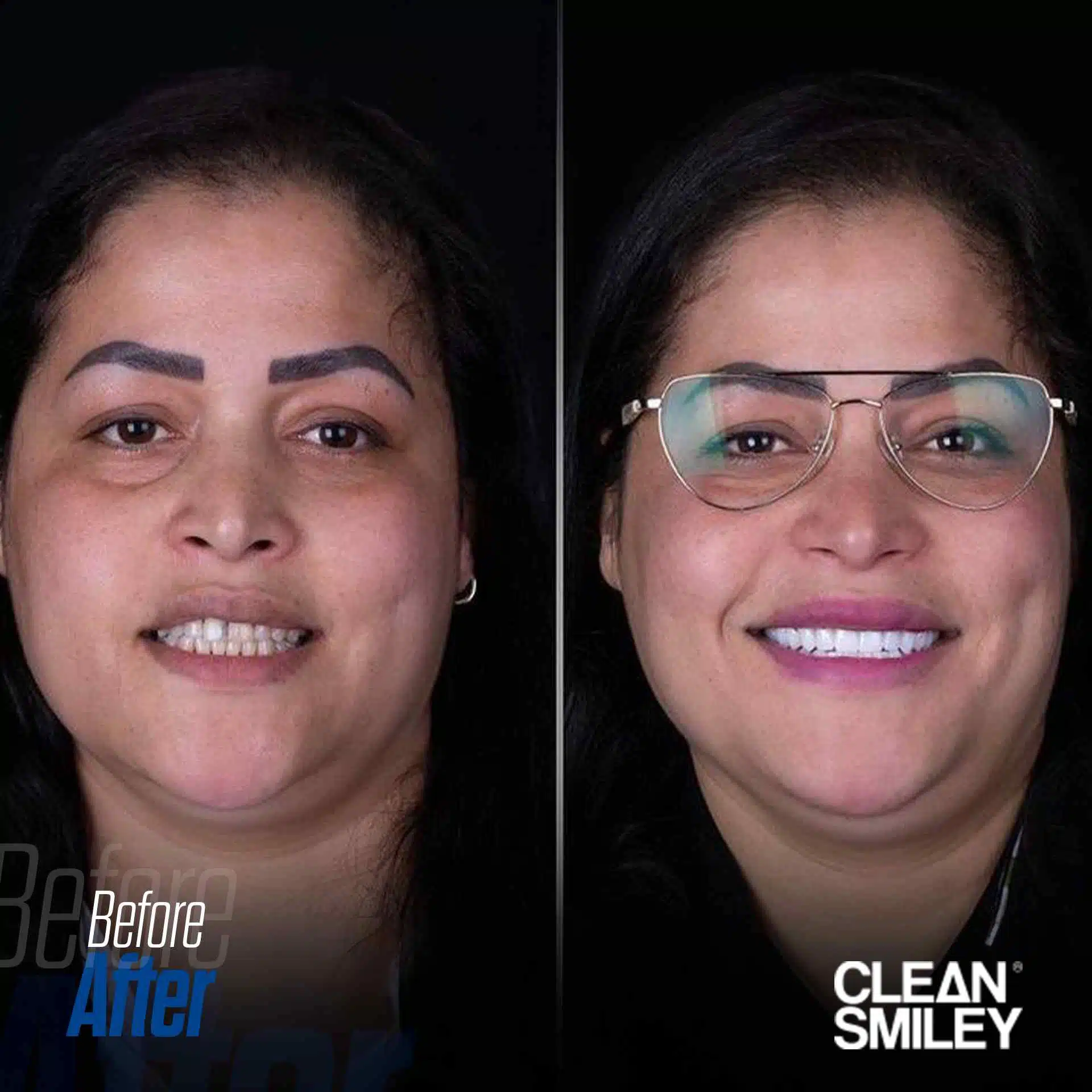 Emax Veneers Turkey