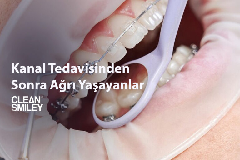 Kanal Tedavisinden Sonra Ağrı Yaşayanlar