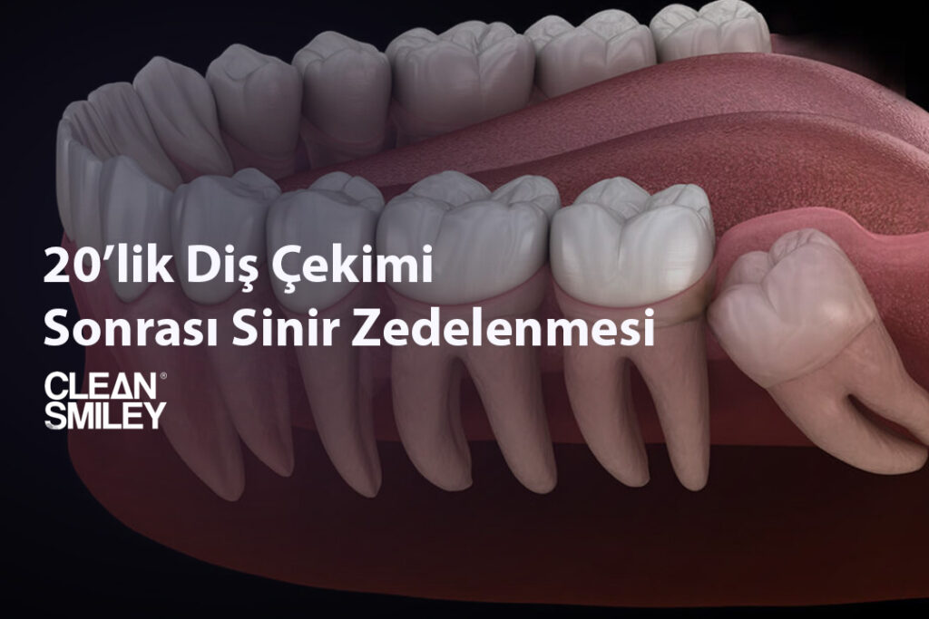 20’lik Diş Çekimi Sonrası Sinir Zedelenmesi