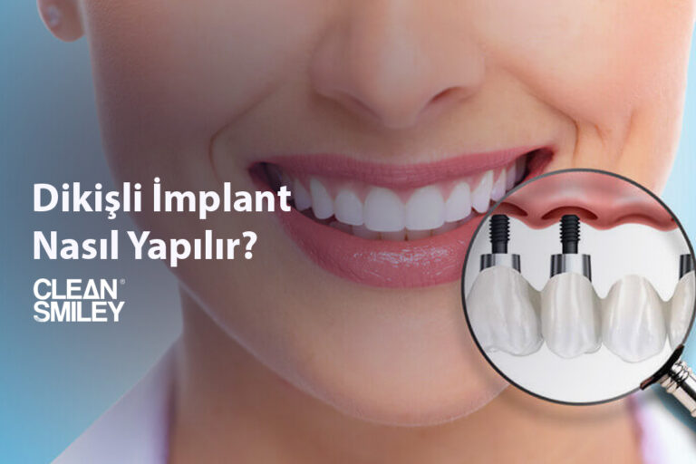 Dikişli İmplant Nasıl Yapılır?