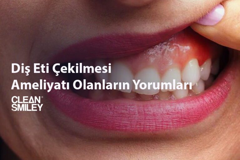 Diş Eti Çekilmesi Ameliyatı Olanların Yorumları