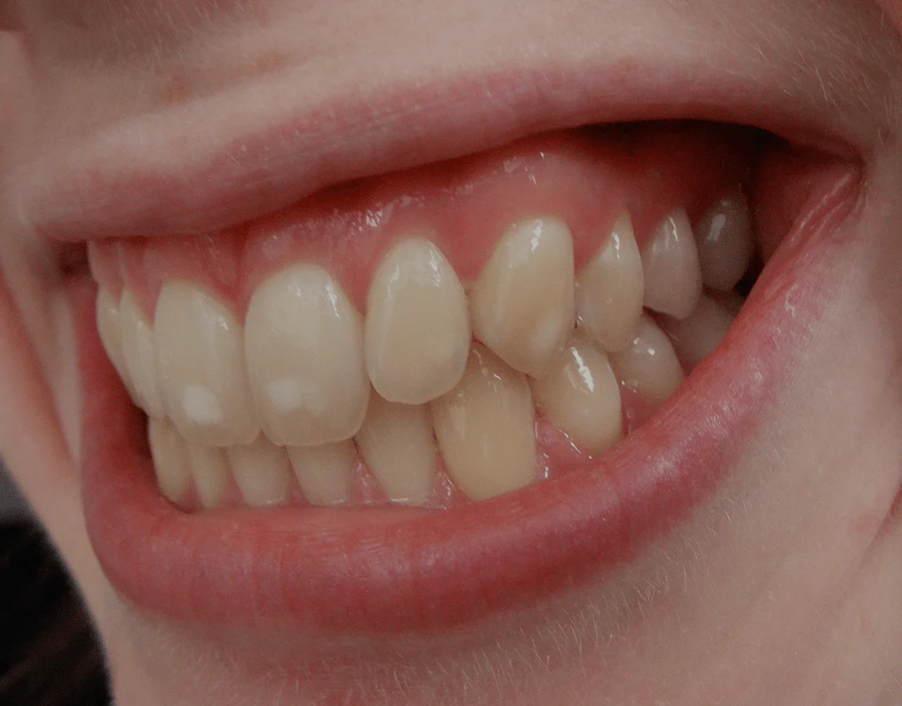 Side view of a smile showing opaque white spots on teeth after whitening in the middle of the upper front teeth