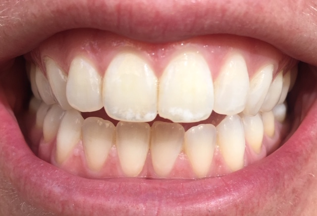 Close-up of upper front teeth with chalky white spots on teeth after whitening along the biting edges