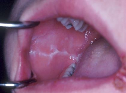 Inner cheek held open with retractors, showing rough white patches along the bite line caused by habitual biting inside of cheek
