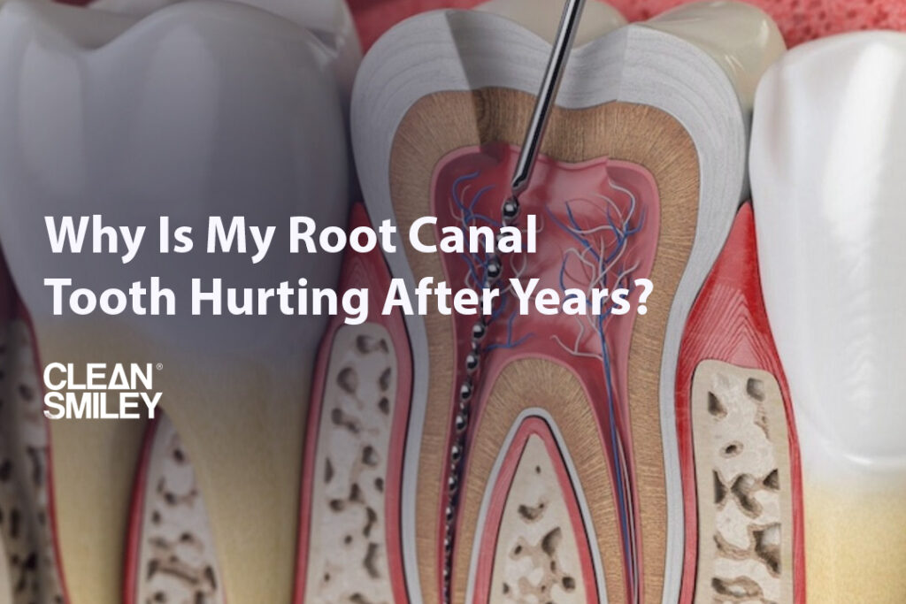 Why Is My Root Canal Tooth Hurting After Years?