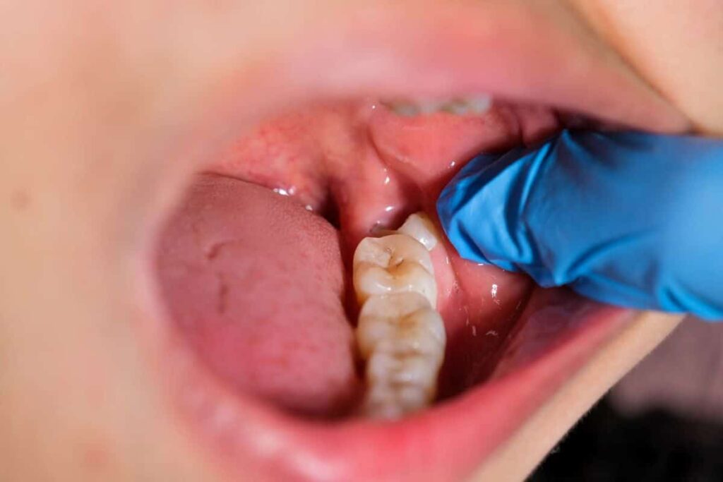 Close-up of an open mouth with a gloved finger holding the cheek back to show a lower wisdom tooth behind the molars, the area to protect when planning what to eat after wisdom teeth removal