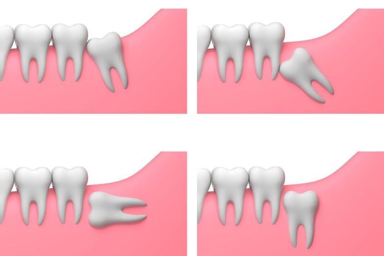 Four 3D illustrations of lower wisdom teeth growing at different angles, from upright to fully sideways, showing why what to eat after wisdom teeth removal varies from person to person