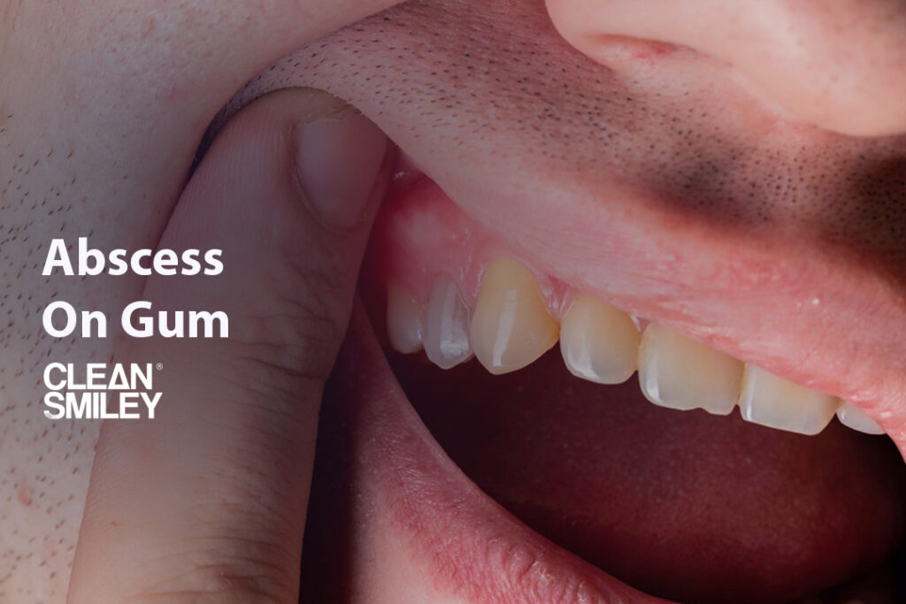 Abscess On Gum