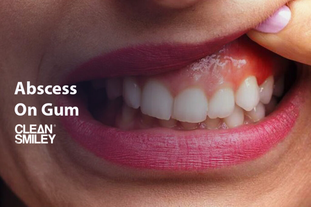 Abscess On Gum