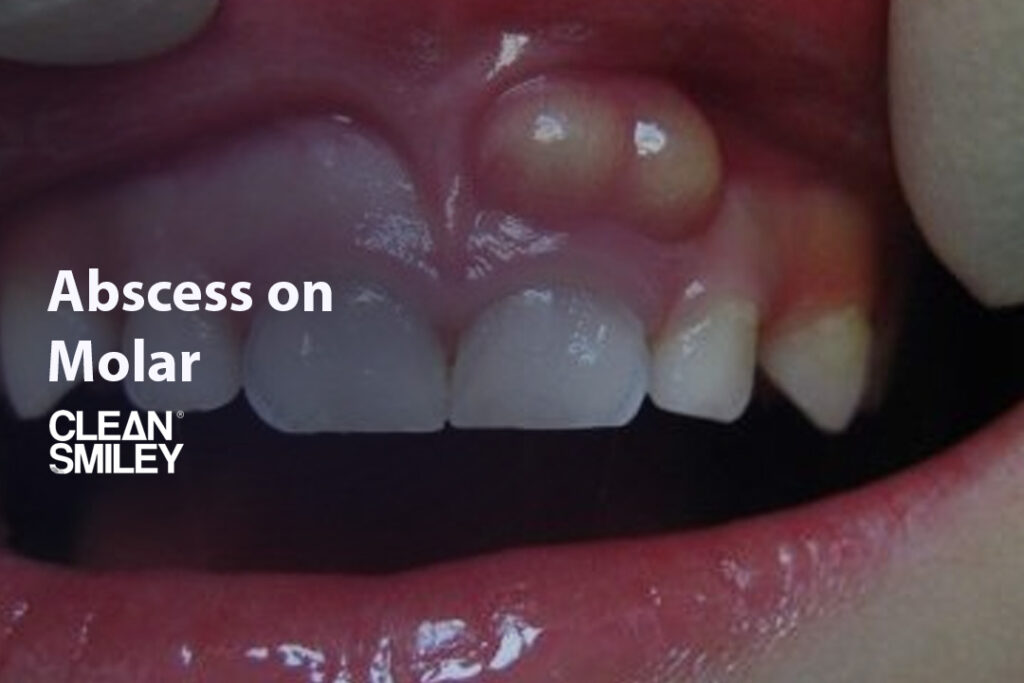 Abscess on Molar