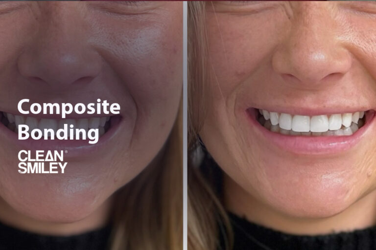 Composite Bonding