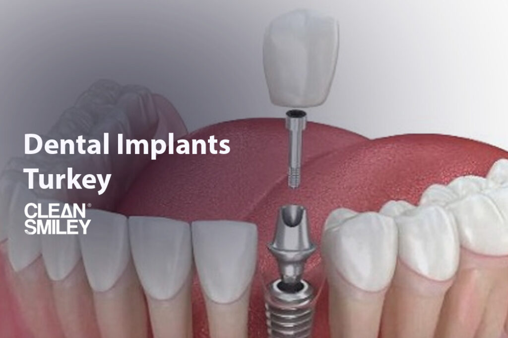 Dental Implants Turkey