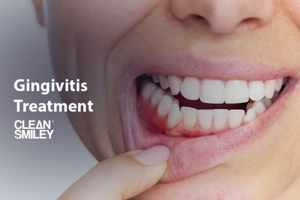 Gingivitis Treatment