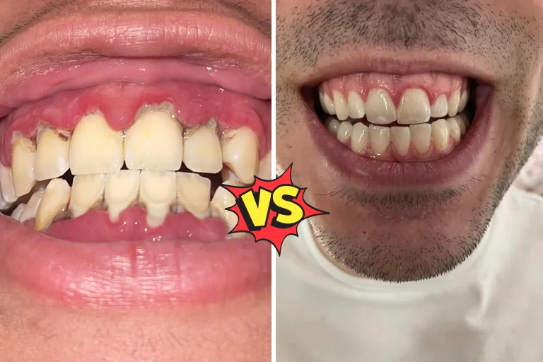 Gingivitis Treatment