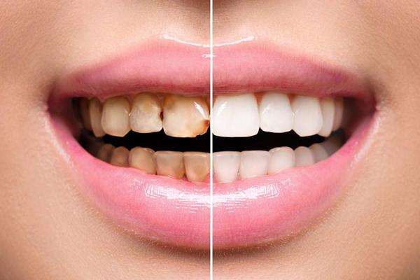 Laminate Teeth Veneer