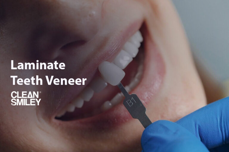 Laminate Teeth Veneer