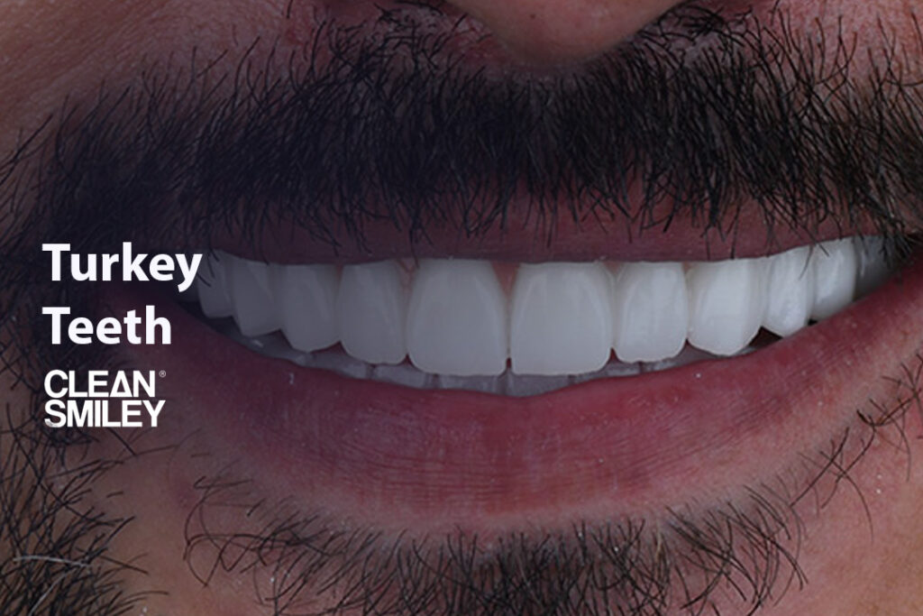 Turkey Teeth