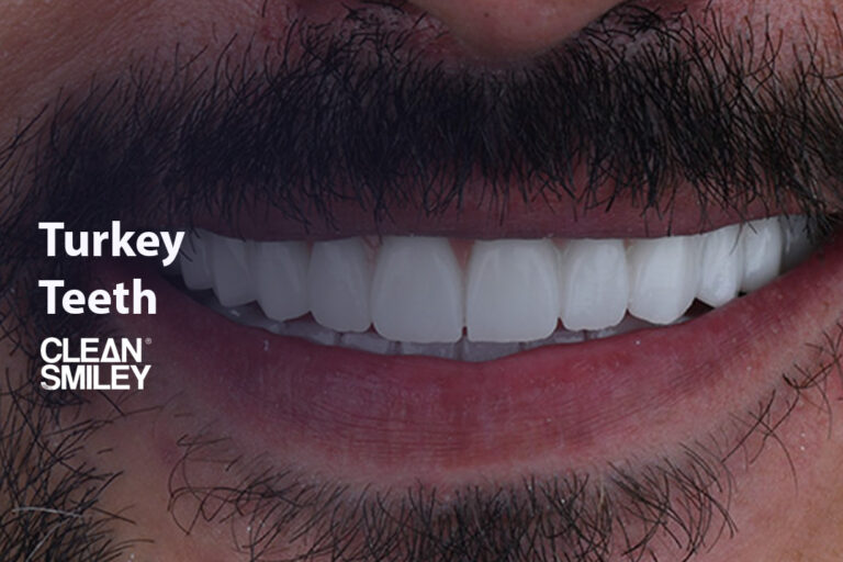 Turkey Teeth