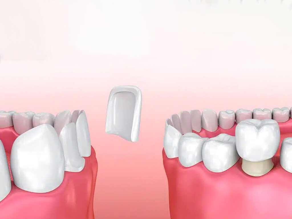 Veneers vs. Crowns