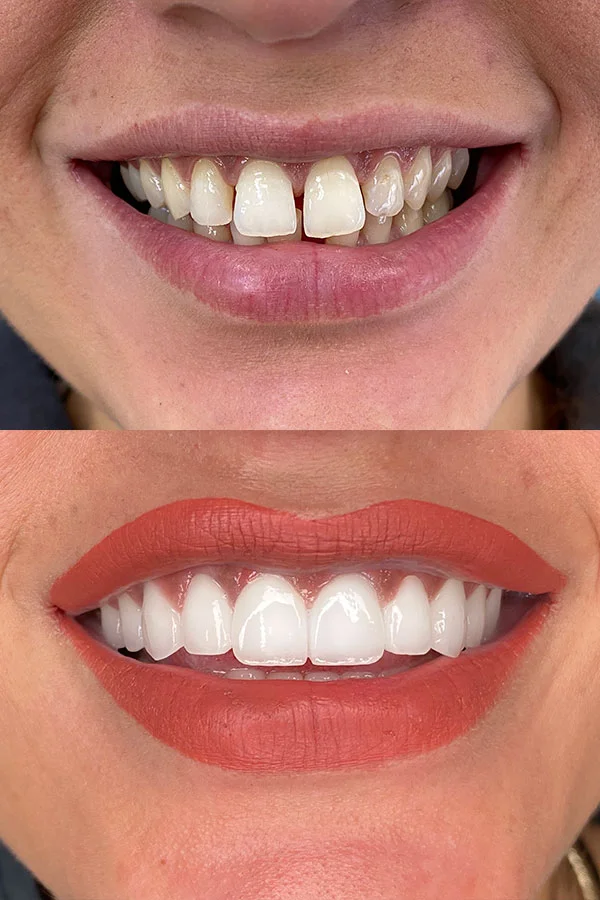 Zirconium Crowns