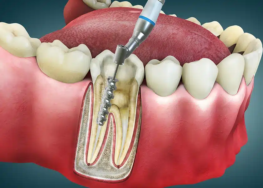 How Long Does a Root Canal Take?