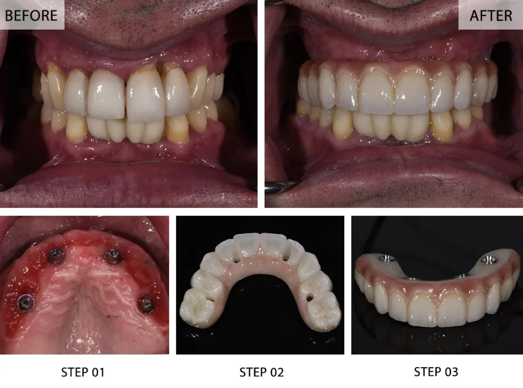 All on 4 Dental Implants