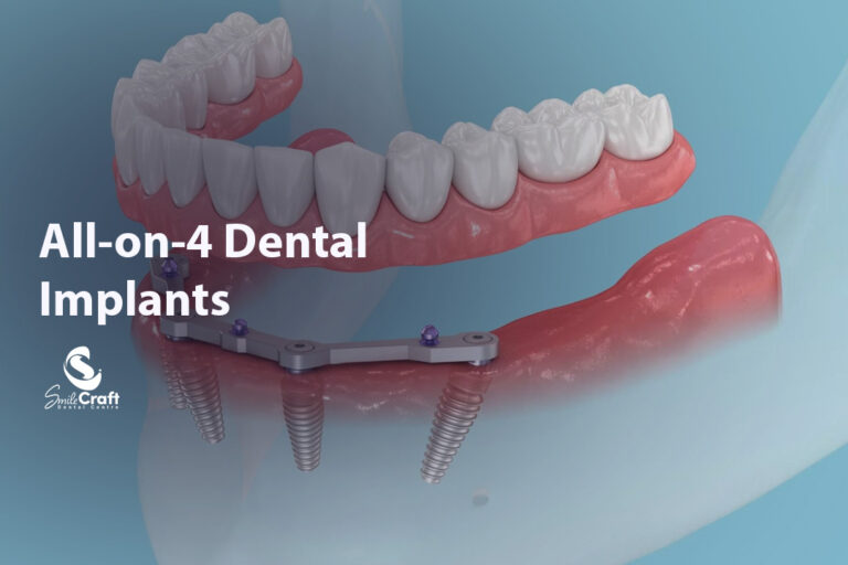 All on 4 Dental Implants