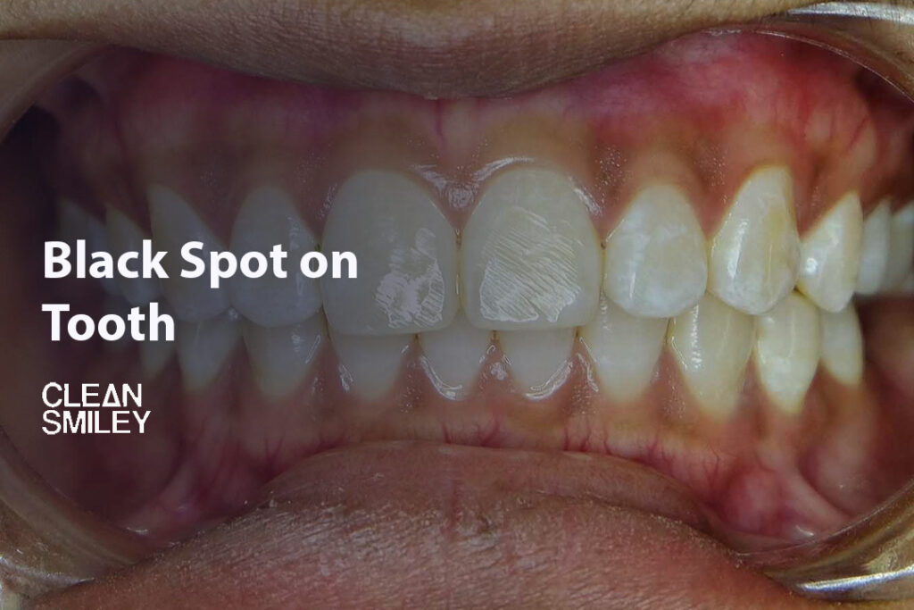 Black Spot on Tooth