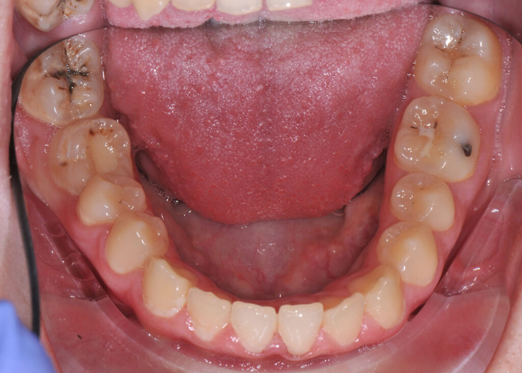 Black Spot on Tooth