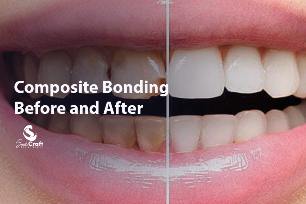 Composite Bonding Before and After