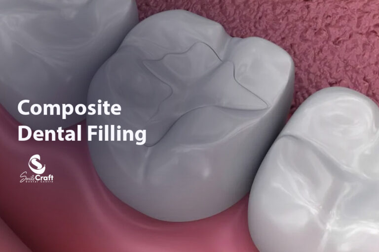 Composite Dental Filling