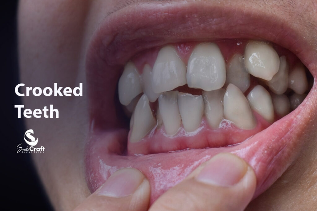 Crooked Teeth