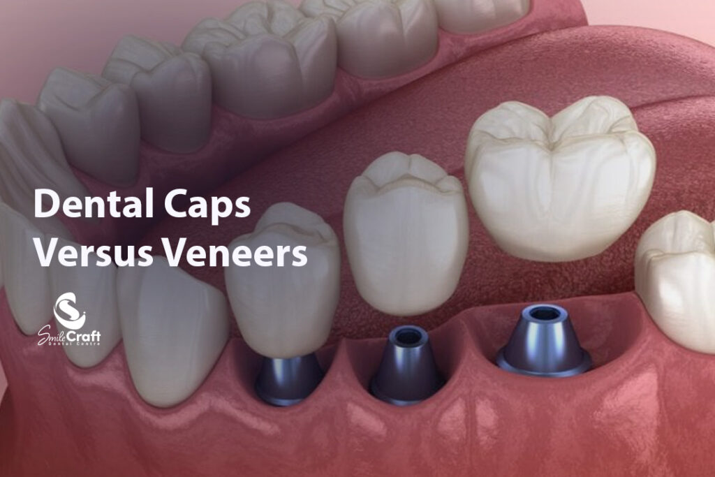 Dental Caps Versus Veneers