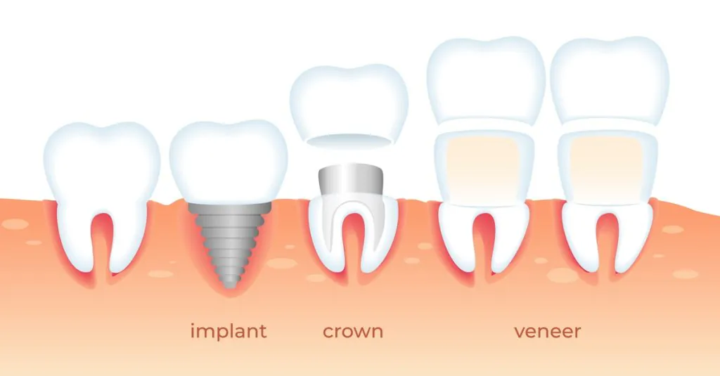 Dental Caps Versus Veneers 1