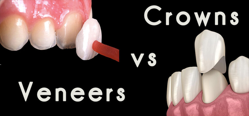 Dental Caps Versus Veneers