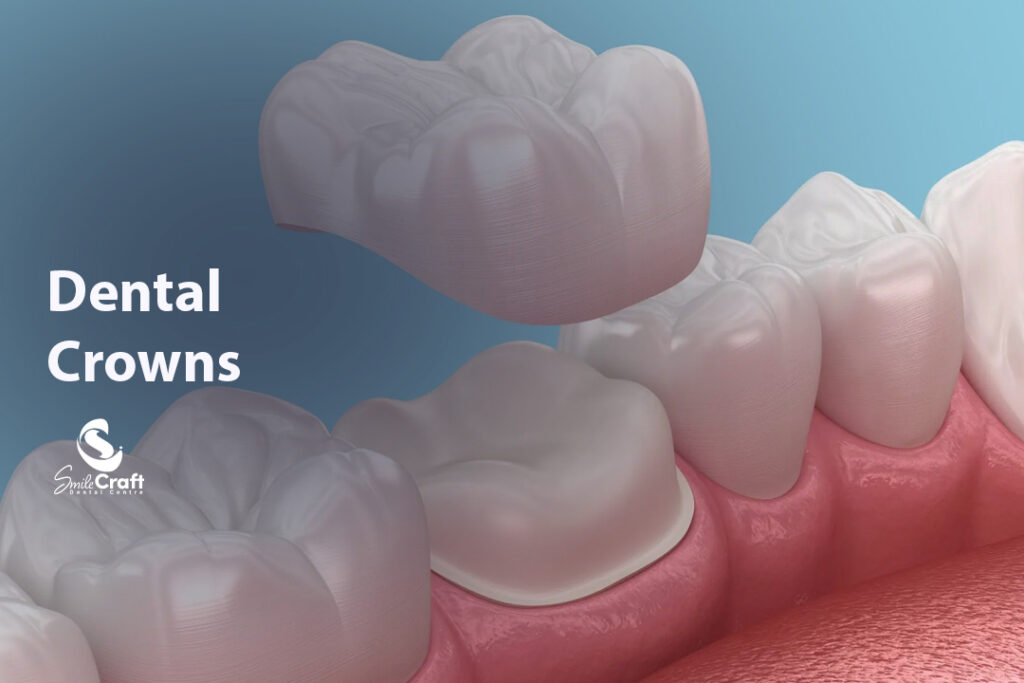 Dental Crowns