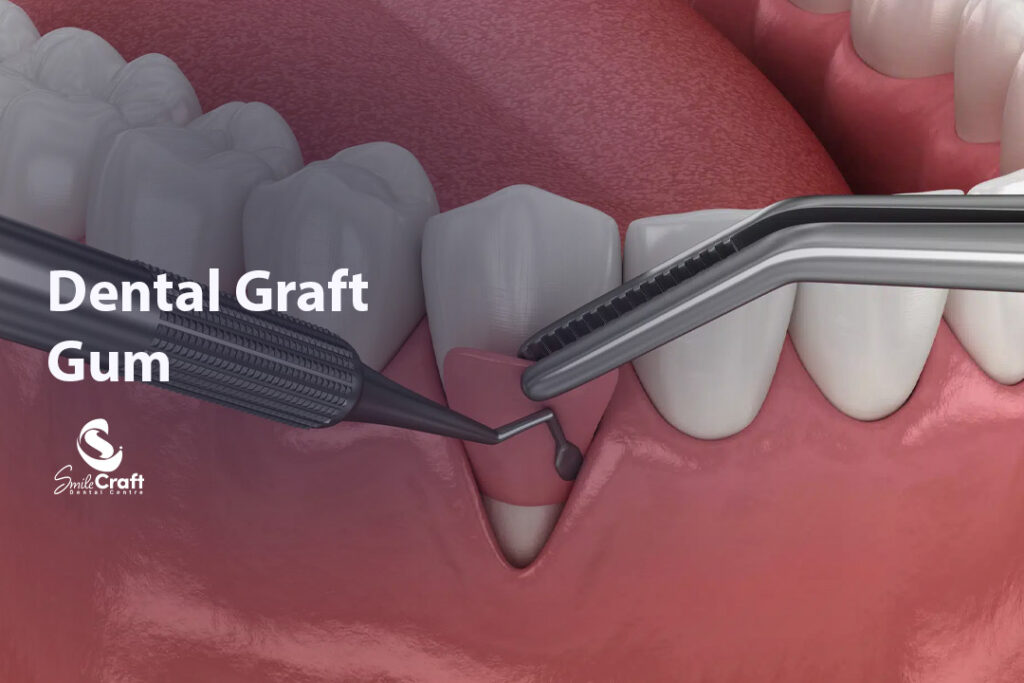 Dental Graft Gum