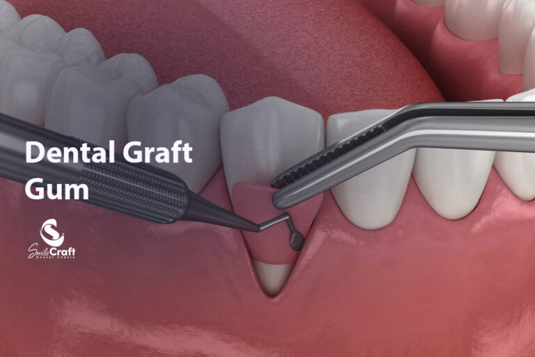 Dental Graft Gum