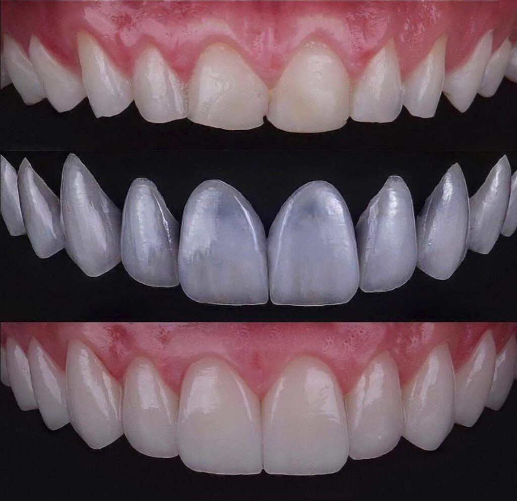 Dental Veneers Emax