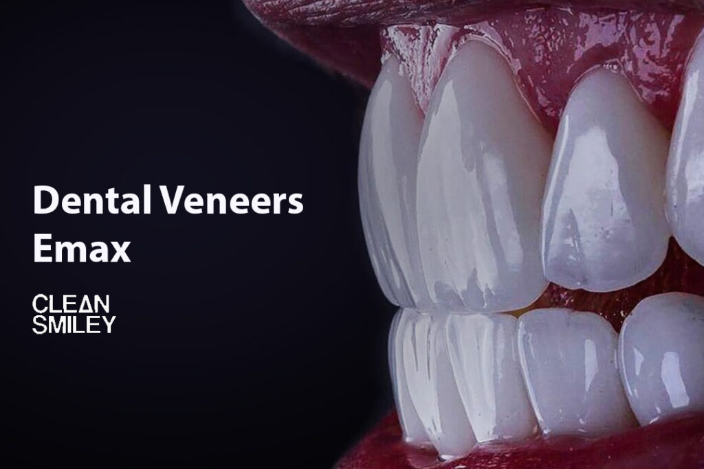 Dental Veneers Emax