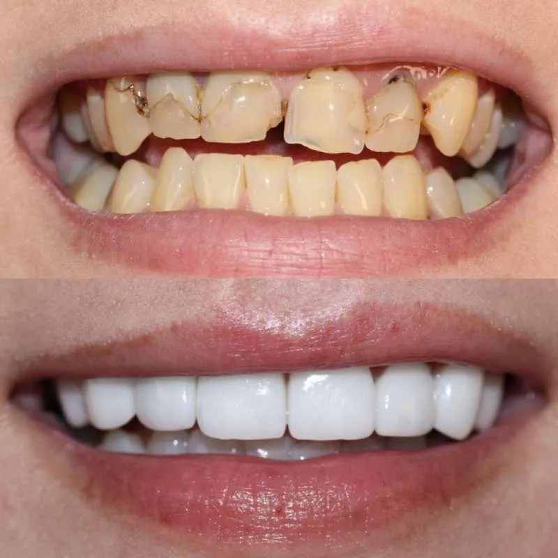 Dental Veneers Emax1