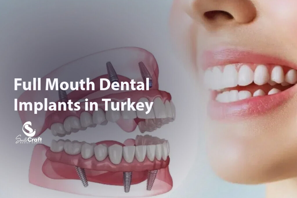 Full Mouth Dental Implants in Turkey