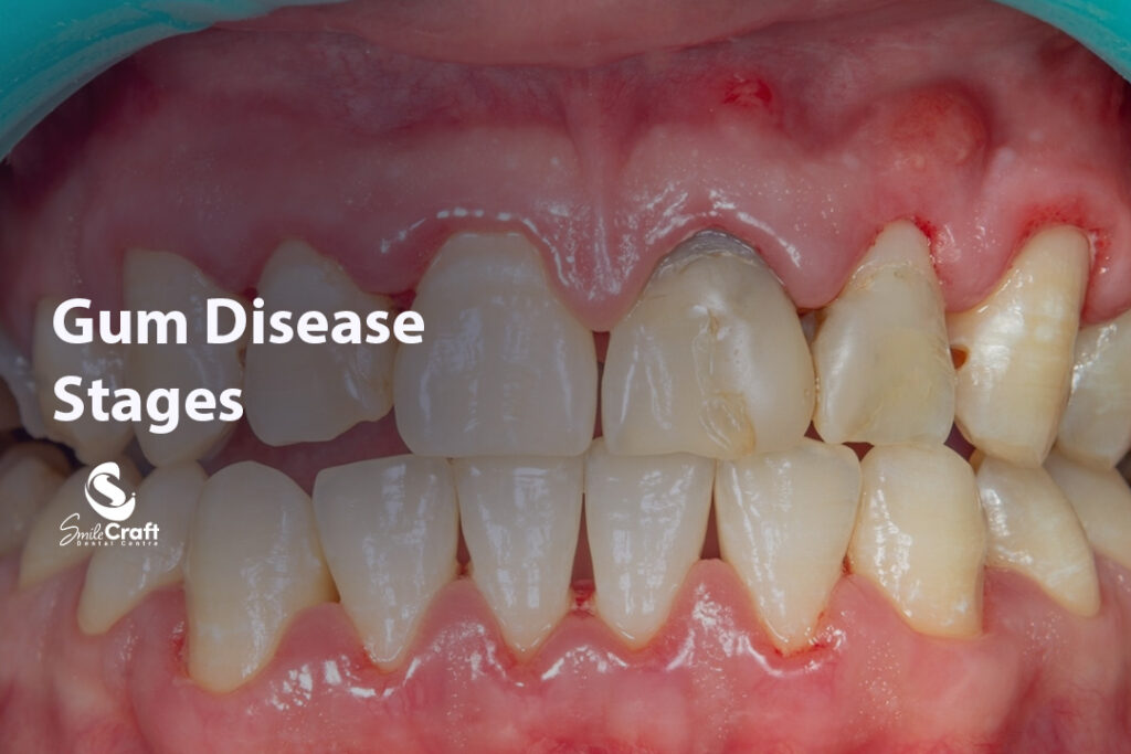 Gum Disease Stages