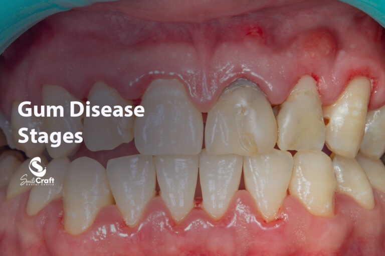Gum Disease Stages
