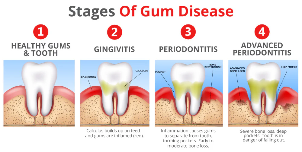 Gum Disease Stages