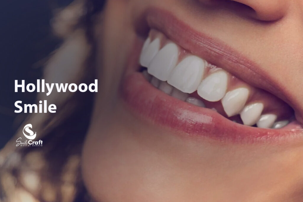Hollywood Smile