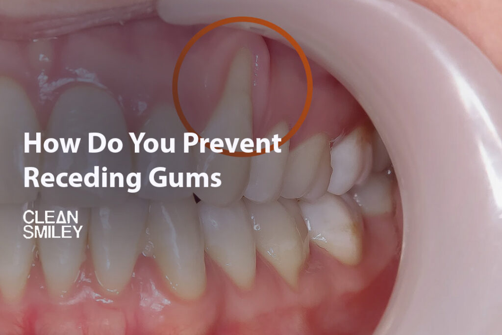 How Do You Prevent Receding Gums