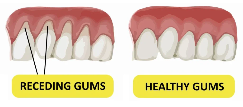 How Do You Prevent Receding Gums