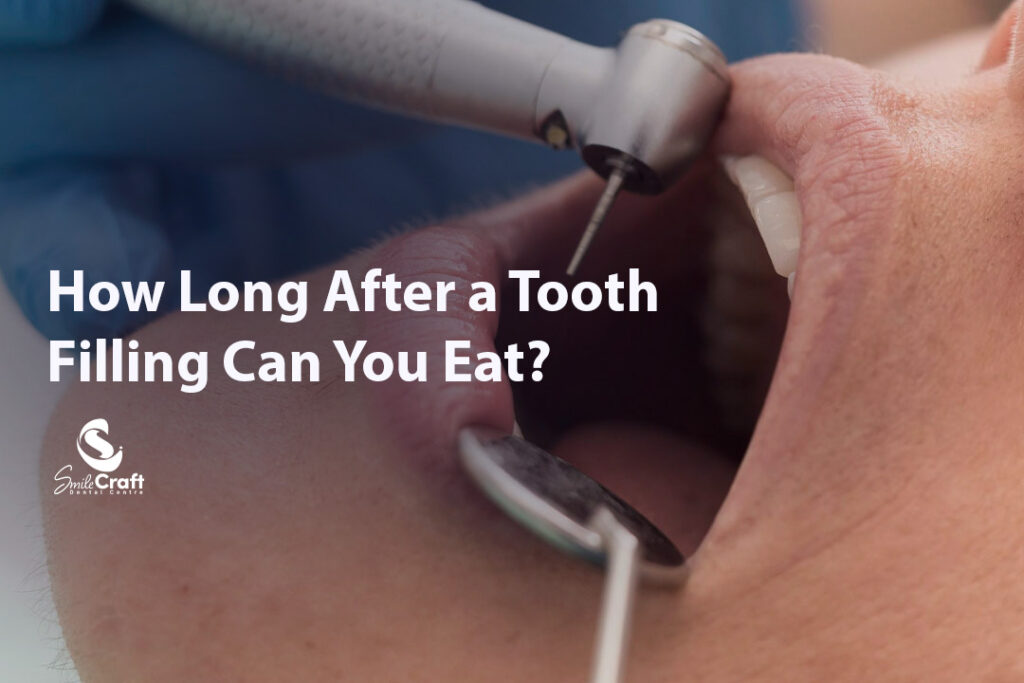 How Long After a Tooth Filling Can You Eat